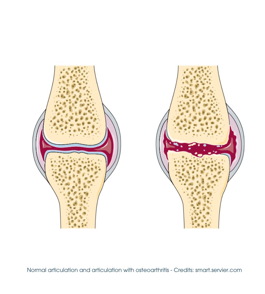 Osteoartrite: confronto fra un articolazione sana e una malata